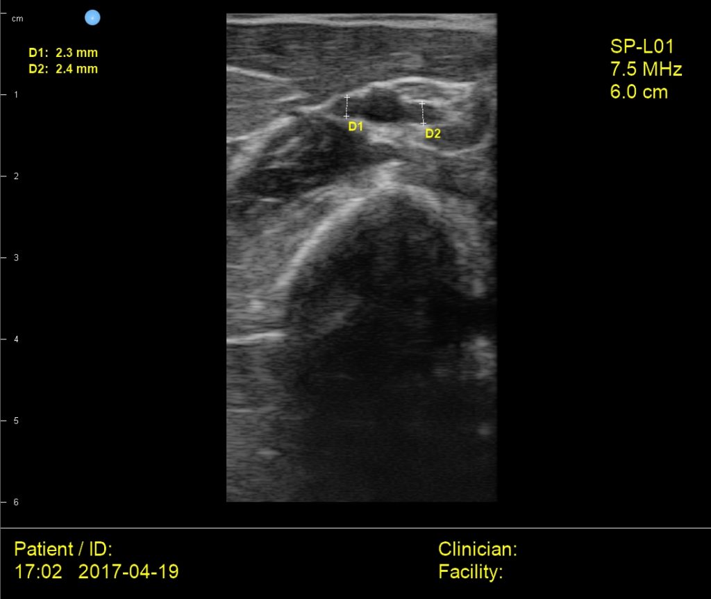 Interson SP Medical Brachial PICC Access Ultrasound Image