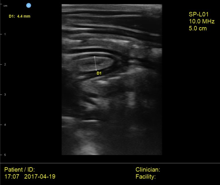 Interson Cat Intestine Ultrasound Image Interson Corporation