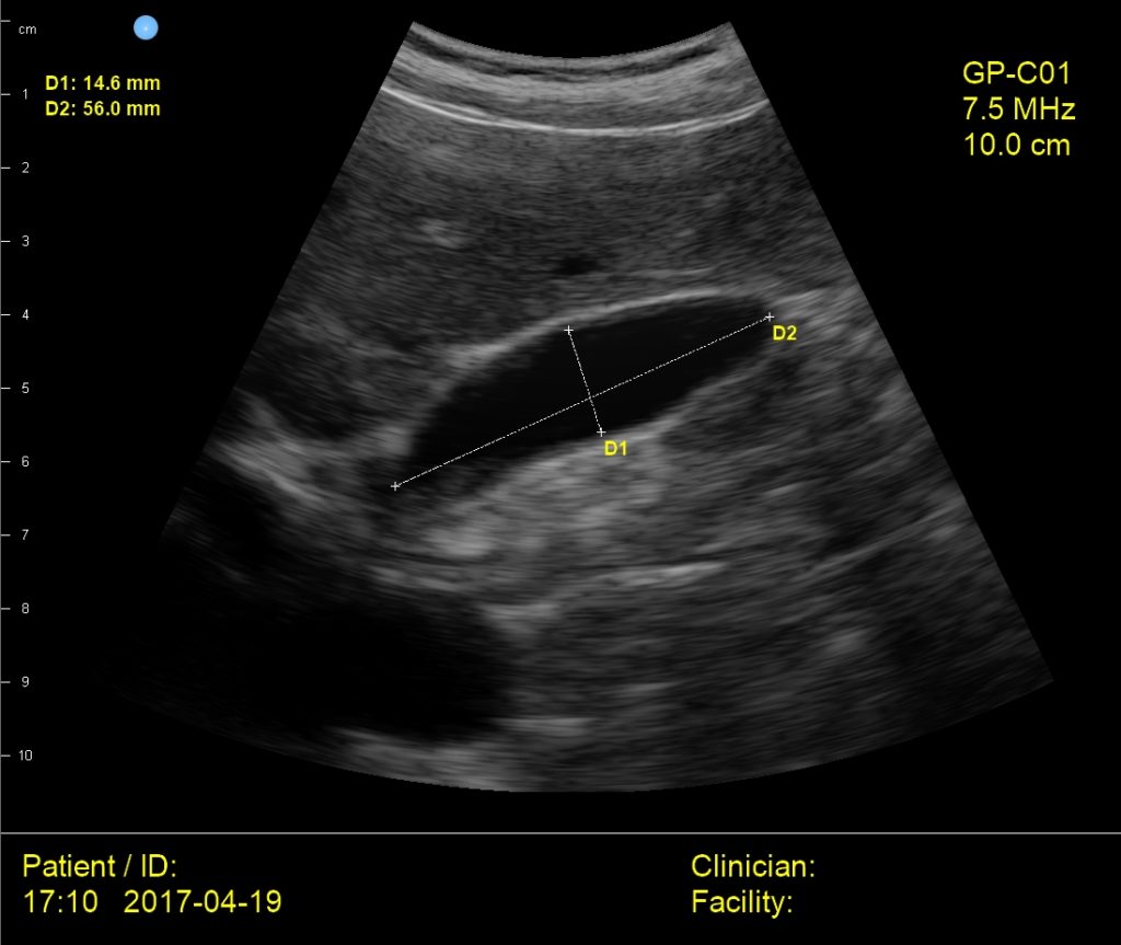Interson GP Medical Gall Bladder Ultrasound Image