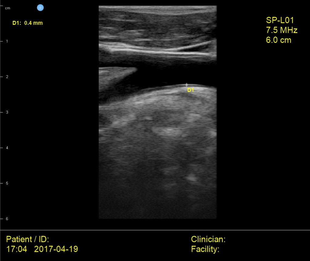 Interson Intima Media Thickness Ultrasound Image