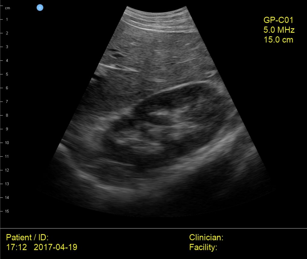 Interson GP Medical Liver Kidney Diaphragm Ultrasound Image