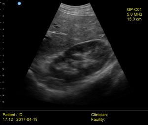 Interson GP Medical Liver Kidney Diaphragm Ultrasound Image