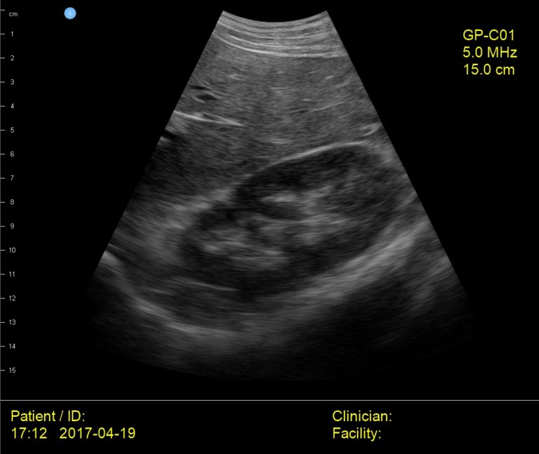 Interson GP Medical Liver Kidney Diaphragm Ultrasound Image Interson