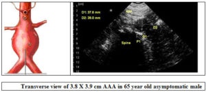 Abdominal Aneurysm