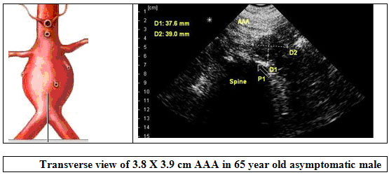 abdominal aorta ultrasound